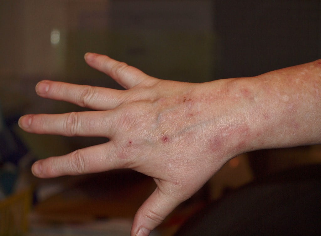 Hvad skal jeg gøre, hvis mit ur giver mig udslæt?